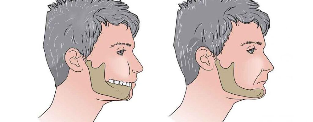 zanik kości szczęk