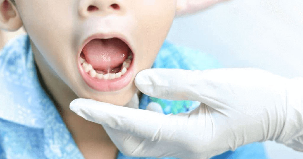 Plastyka wędzidełka języka - co to jest?