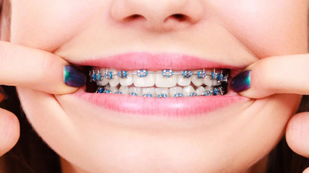 aparat ortodontyczny