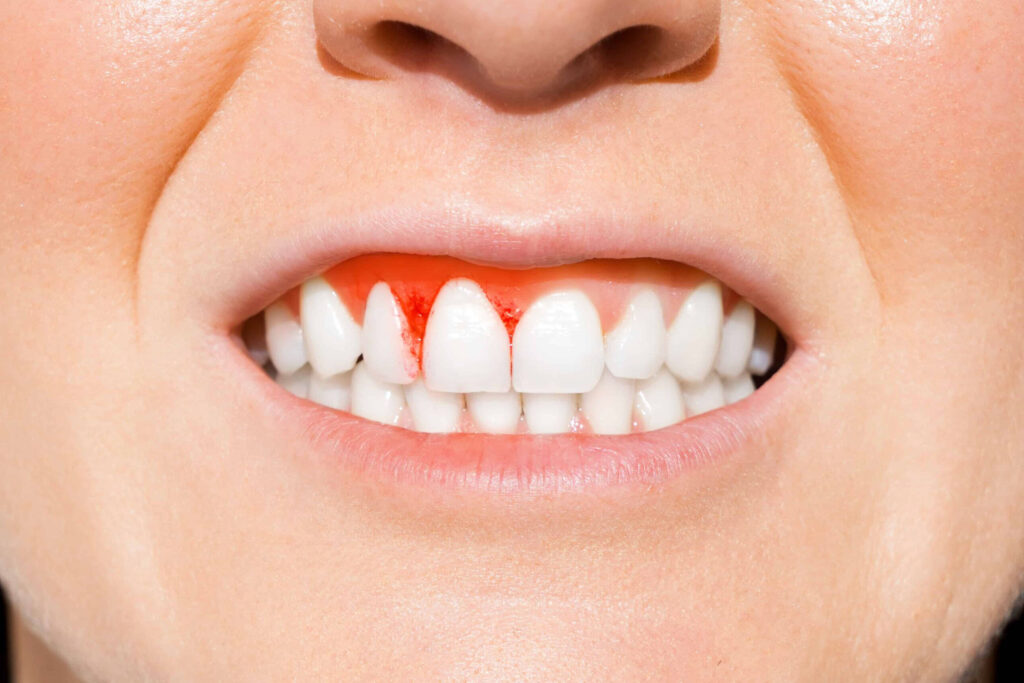 cukrzyca w jamie ustnej