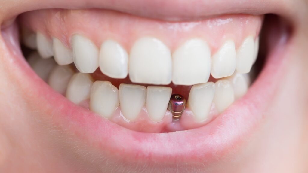 Implanty na całe życie, Szwajcarska precyzja i jakość.